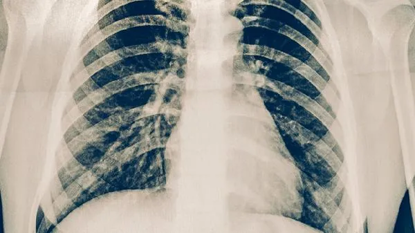 肋软骨炎怎么治疗效果好呢
