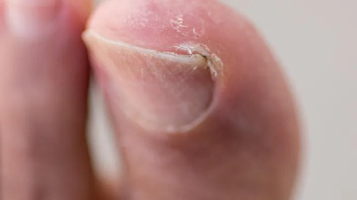 甲沟炎疾病的中成药治疗