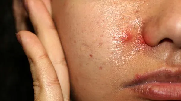 穿掘性毛囊炎的危害