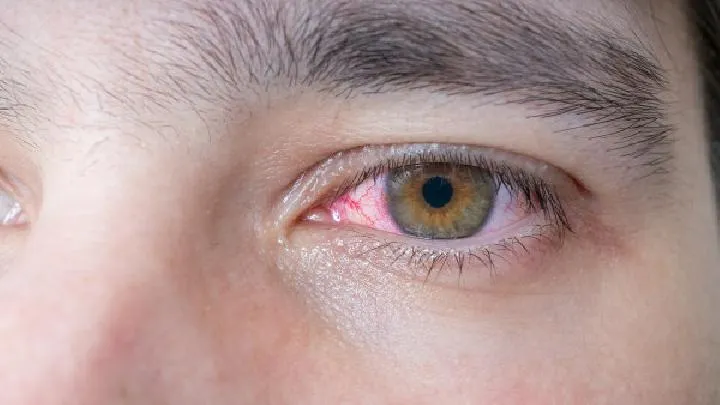 慢性泪囊炎的护理方式是什么
