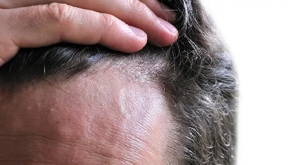 肾虚脱发是什么原因 肾虚脱发吃什么好