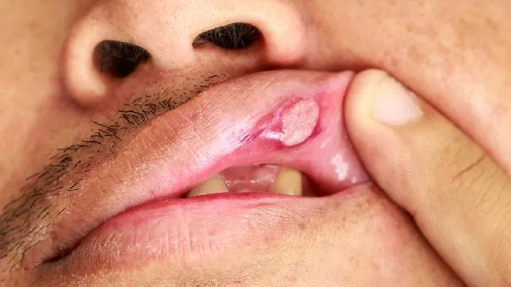 避免口腔溃疡怎么护理口腔？口腔溃疡久治不愈怎么办好？