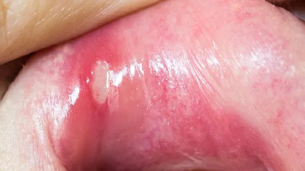 青椒为什么治口腔溃疡