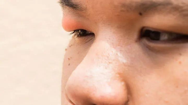 霰粒肿如何治疗呢
