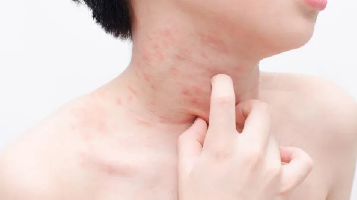 皮肌炎的疾病诊断标准是什么？