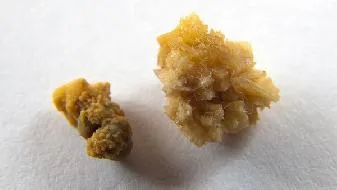 肾病综合症中期护理