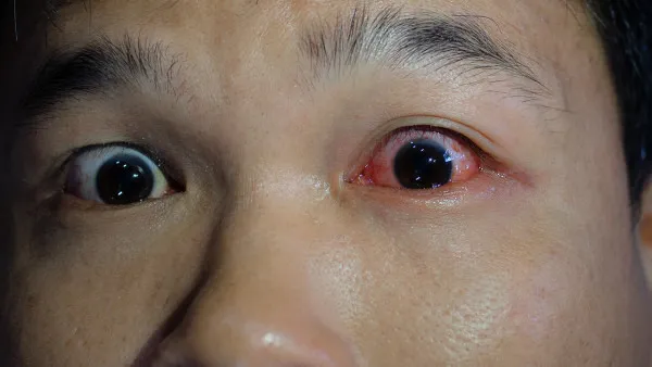 白眼球老有红血丝是怎么回事 白眼球老有红血丝该怎么进行治疗