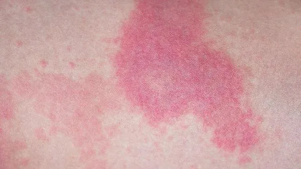 儿童紫癜的症状