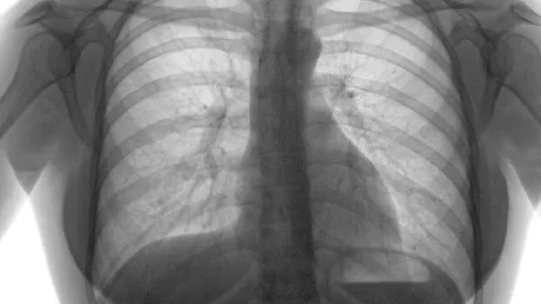 先天性肺囊状腺样畸形需要手术吗
