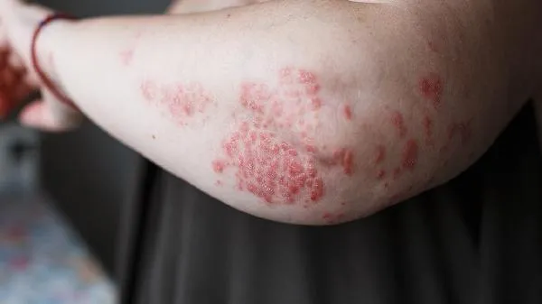 中医治疗牛皮癣的方法