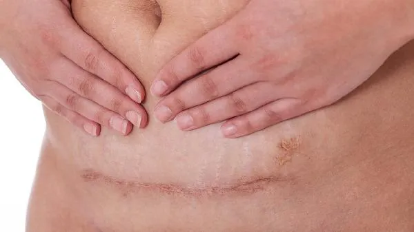 剖腹产后小便处出血
