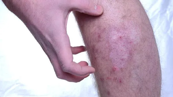 婴儿湿疹是热出来的吗