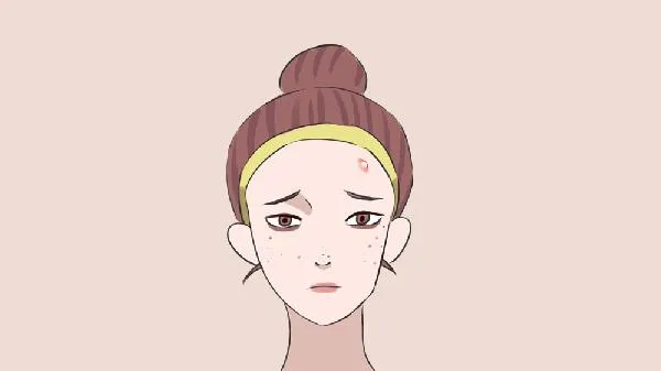 痘印去除还会复发吗