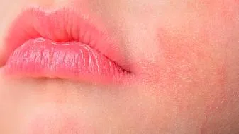 荨麻疹型药疹该怎么治疗  发生的病因和症状有哪些