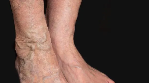 暴食三天全身浮肿尤其是大腿