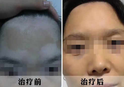 为救丈夫看病放弃治疗白癜风