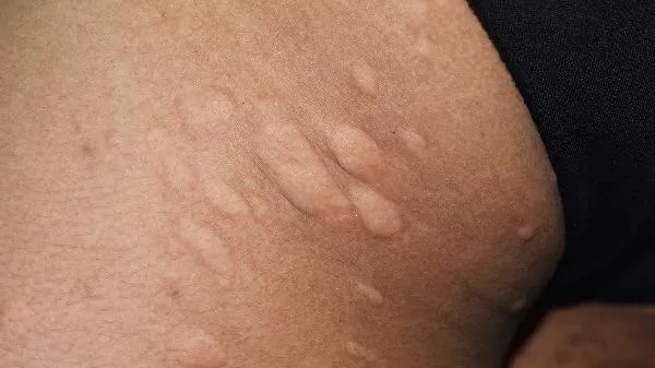 全身皮肤肌肉撕裂的原因是什么