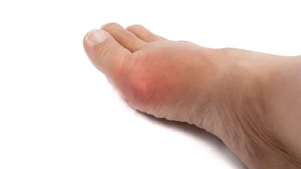 跑步导致脚踝肿胀疼痛怎么办