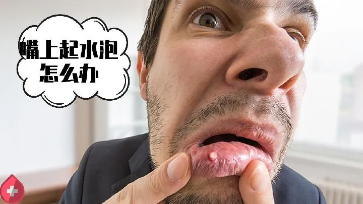嘴起泡按摩3大去火穴