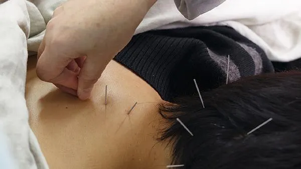 中医埋线能减肥吗
