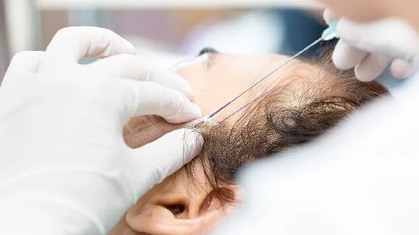 埋线减肥一般要做几次