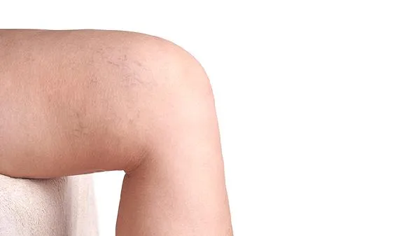 粗大的小腿可以通过抽脂解决吗？