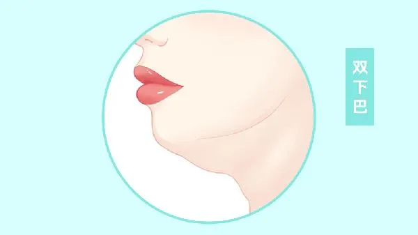 双下巴抽脂术痛苦吗