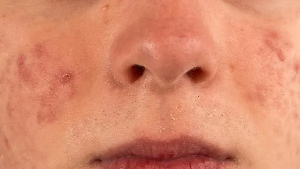 如何选择好的瘦脸方法
