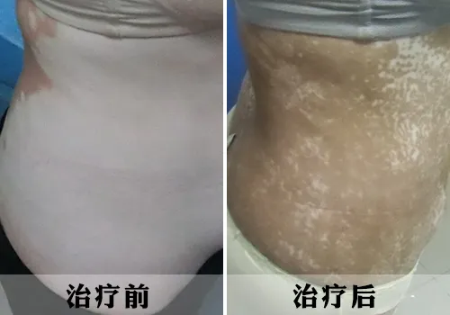 专家助我战胜白癜风重回职场