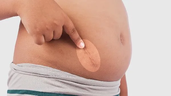 如何判断是腹部肌肉拉伤还是内部疼