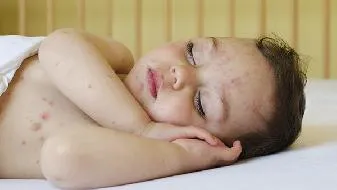 教你巧妙避开长痘痘的五个秘诀