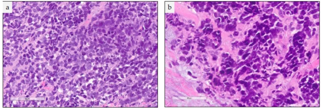 一位男性小细胞肺癌患者的药物治疗历程