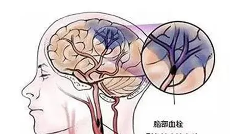 脑血栓和脑梗塞是一回事吗，是同一个病吗？