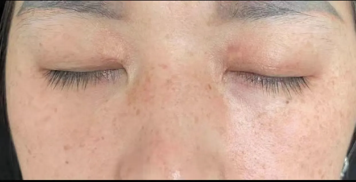 激光治疗让47岁睑黄瘤女性患者重返美丽