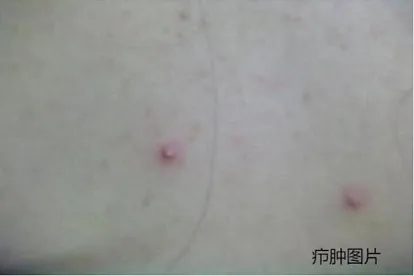 【小腹上长了个红色脓包的原因】