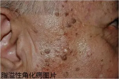 老年脂溢性角化病的图片