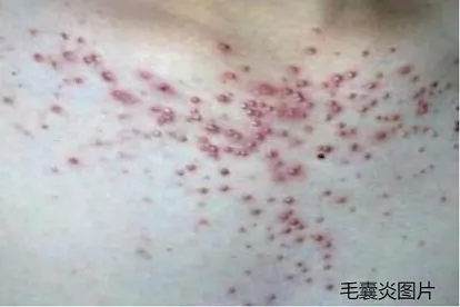 【小腹上长了个红色脓包的原因】