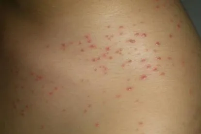 【马拉色菌毛囊炎的病因】
