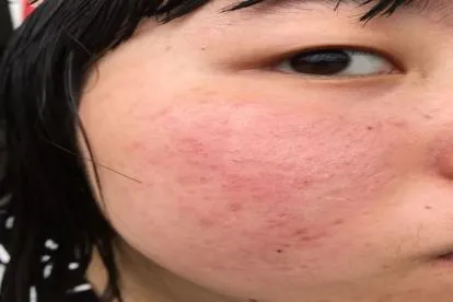 脸上皮炎图片和症状