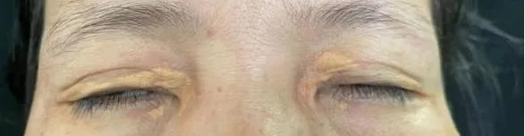 脸上长睑黄瘤