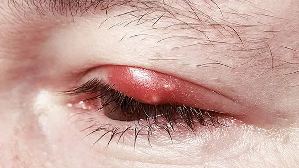 辣椒辣眼睛最有效的方法