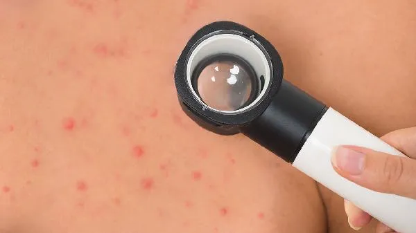 黄桃吃多了会怎么样 黄桃吃多了会过敏吗