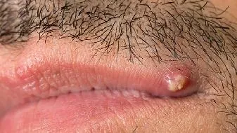 男性秃顶会遗传吗？男性秃顶是肾虚吗？