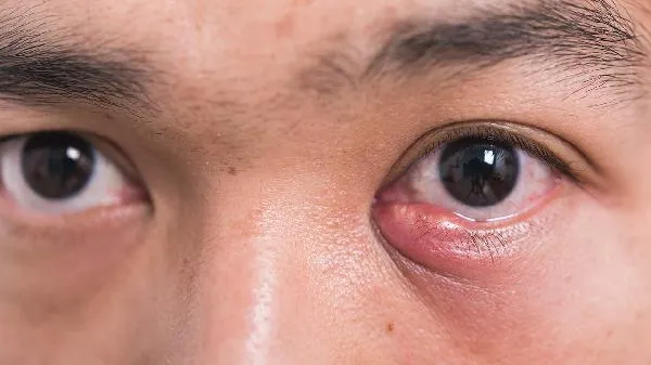 辣椒不小心辣到眼睛怎么办
