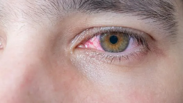 哪种眼药水效果好