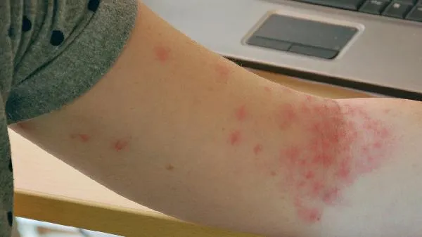 被针扎了会感染艾滋病吗