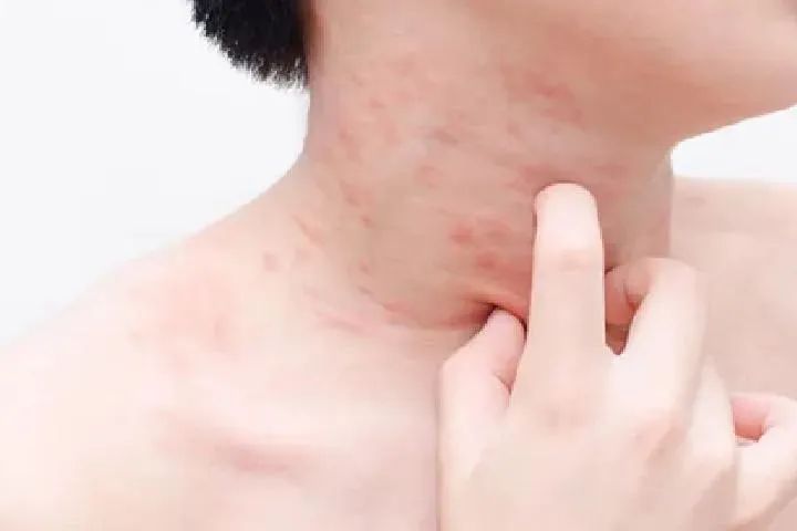 荨麻疹五种食物不能吃
