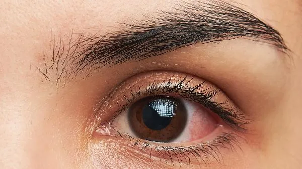 熊猫眼征怎么治疗